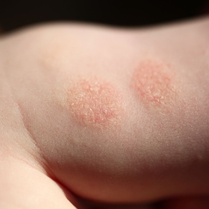 La aparición de la dermatitis atópica suele ser temprana, incluso antes de los 6 meses de edad,