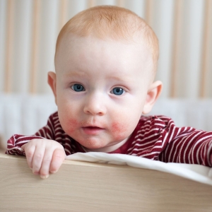 Consejos para prevenir y cuidar la dermatitis atópica