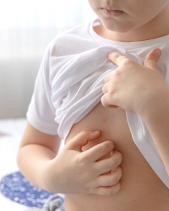 Niño rascándose por dermatitis atópica